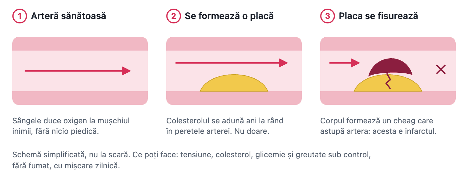 Cum se produce un infarct, în trei pași: arteră sănătoasă, placă de aterom în peretele arterei, placa se fisurează și un cheag astupă artera